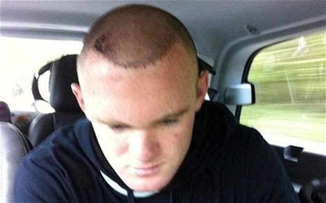 Wayne Rooney hajbeültetésen járt